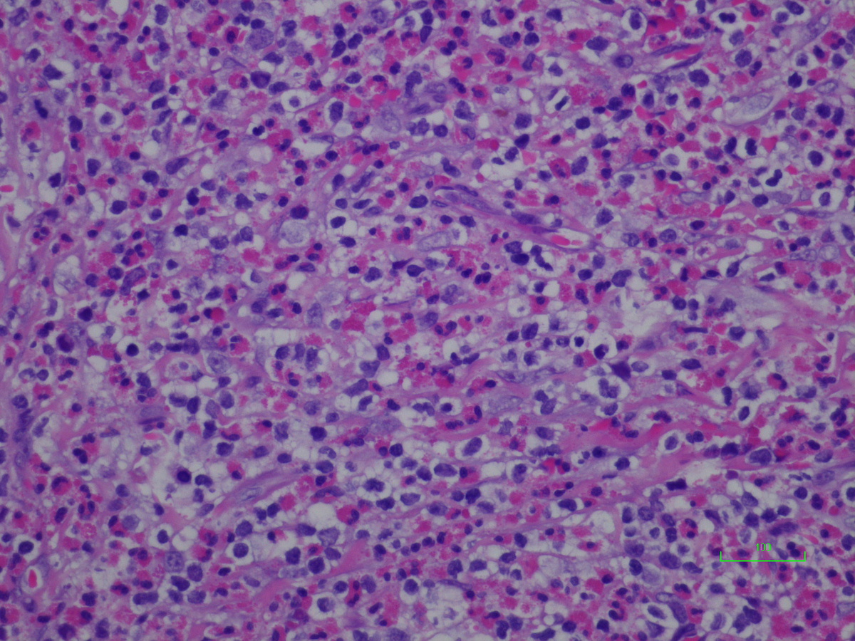 Orbital lesion, 200x